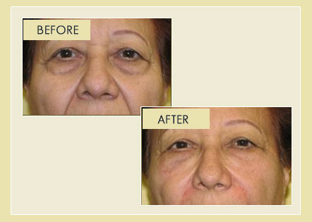 Facial Rejuvenation - Non-Surgical Blepharoplasty