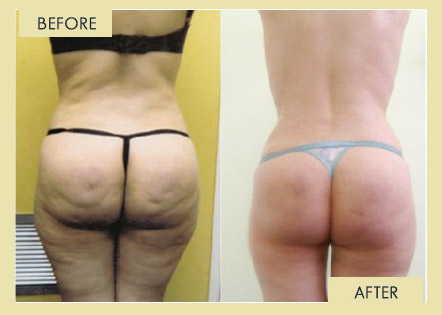 Cellulite Removal Surgery