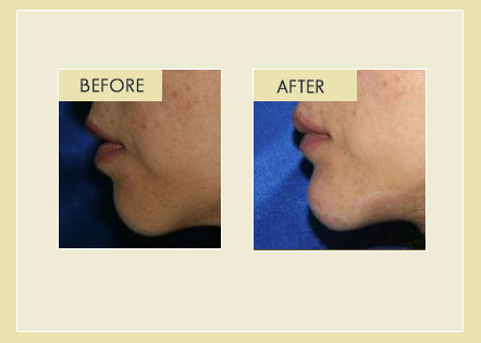 Facial Rejuvenation - Chin Augmentation