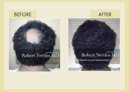 Services - Hair Transplant