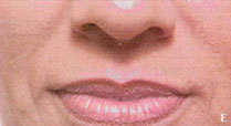 Juvederm