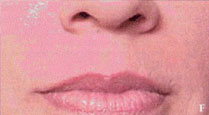 Juvederm
