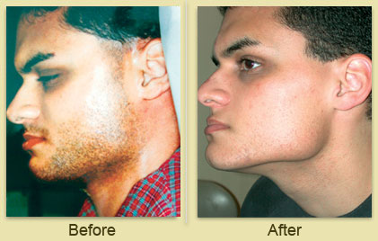 Laser Hair Removal