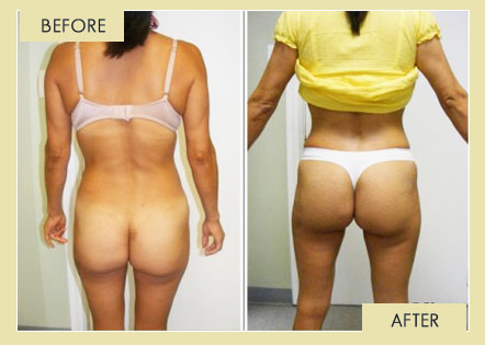 Lifting of Glutes