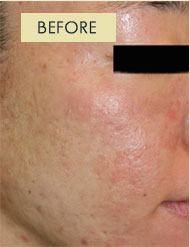 Radiesse Treatment