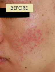 Radiesse Treatment