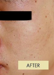 Radiesse Treatment