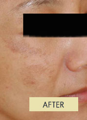 Radiesse Treatment