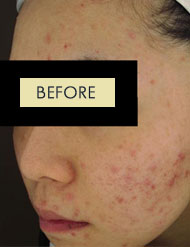 Radiesse Treatment