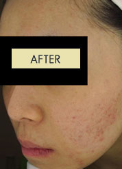 Radiesse Treatment