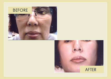 Facial Rejuvenation - Removal of Laugh Lines