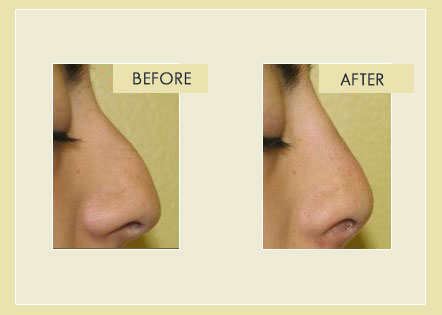 Facial Rejuvenation - Rinoplasty